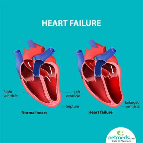 poor lv function|signs of left heart failure.